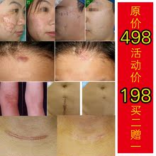 痘印黑色素沉淀怎么解决