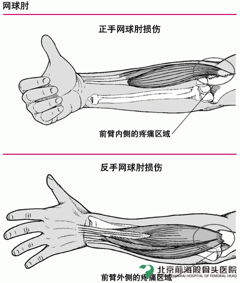 网球肘专用贴膏 网球肘治疗 舒肘通筋贴 手臂疼痛 无力