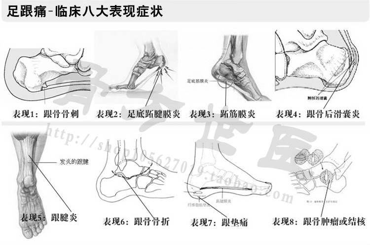 00元】足跟骨方世医贴 足跟痛 足跟骨刺 足底跖筋膜炎 黑膏 康消帖