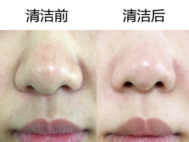 素颜神器美容仪实测,告别黑头不伤肤