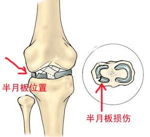 治疗半月板损伤有什么比较好的方法