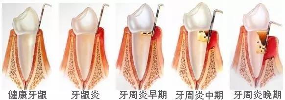 牙周炎如何治疗?