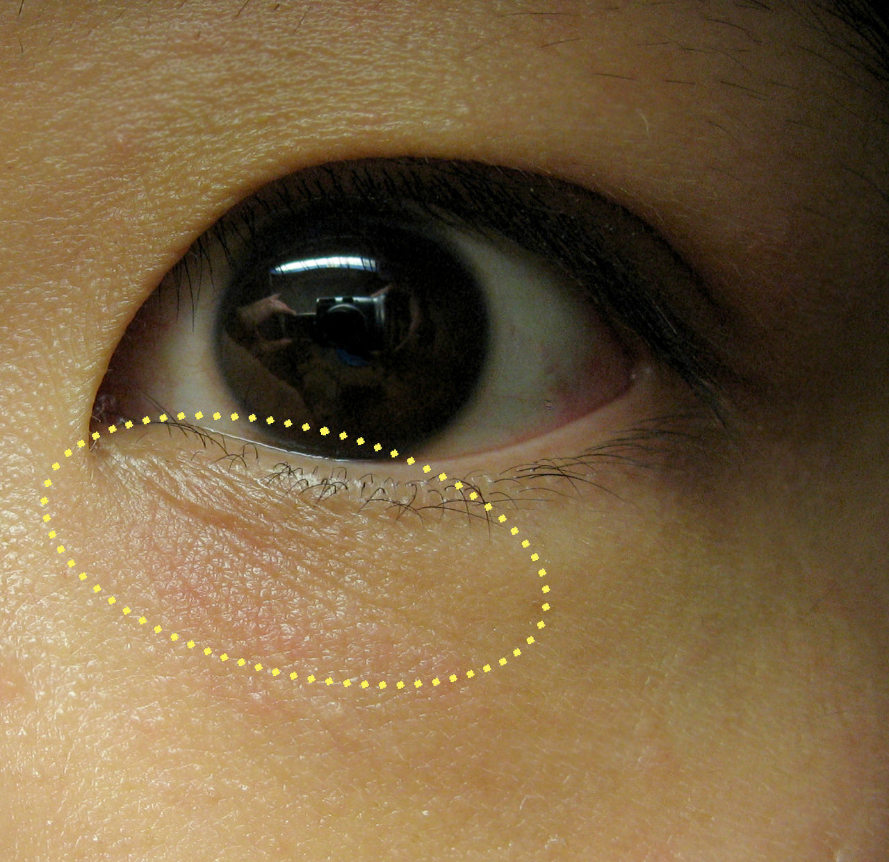 1秒钟 爱美眉如何快速辨别眼部真假细纹?