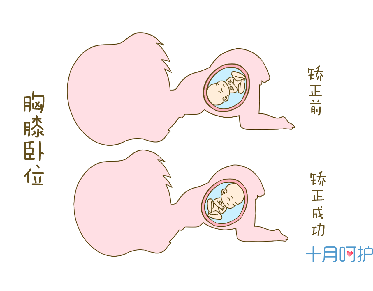 胎位不正,要顺产跟我左手右手一个慢动作