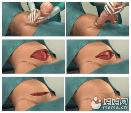 剖腹产和顺产宝宝,不同在哪裏?