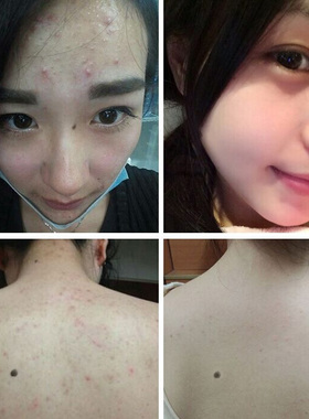 【祛痘神器】快速祛青春痘 脸上 背上 见效更快 皮肤0刺激