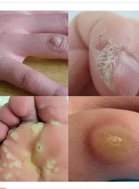 周氏去瘊膏去除鸡眼瘊子贴刺瘊跖疣鸡眼膏疣不复发正品