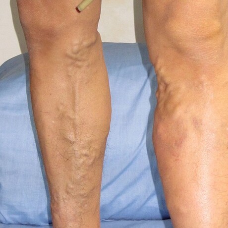 脉舒膏 静脉膏曲张腿部药膏青筋血管凸起扩张买二送一