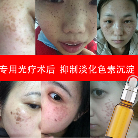 上海九院专用 左旋vc 抑制激光后黑色素沉淀淡化去色素斑反黑回流