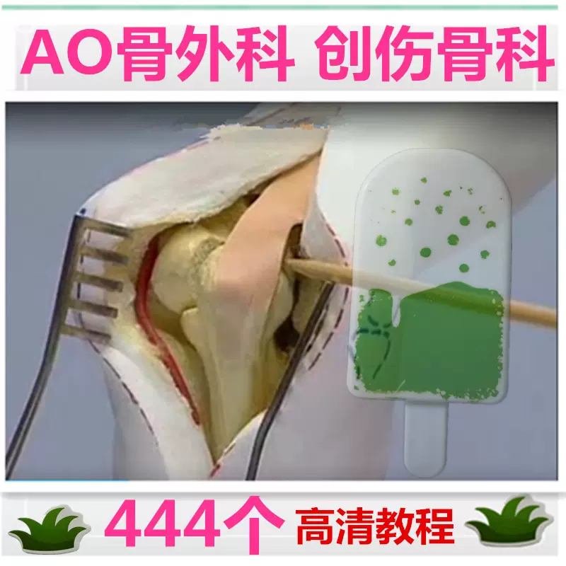 下肢骨折治疗方法21集骨科手术视频胫骨转子间股骨干骨折关键技术