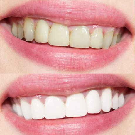 【空姐直供】牙齿白白白~微微一笑很倾城~~kiss神器