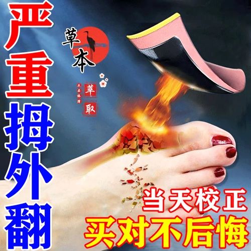 Большой палец от большого пальца и большой палец в коррекции большого пальца, перекрытие пальцев, боль деформируется, отек опухшей ног и мази и мазь