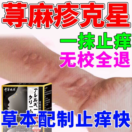 Крапивница мази для лечения зуда кожи и эритемы острая хроническая крапивница аллергия и облегчить зуд специальной мази