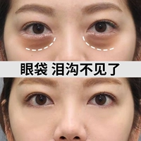 [Рекомендуется xiaohongshu Live Room] Не позволяйте мешкам под глазами подвергать ваш возраст, чтобы уменьшить сумки под глазами и стрелять в два волоса