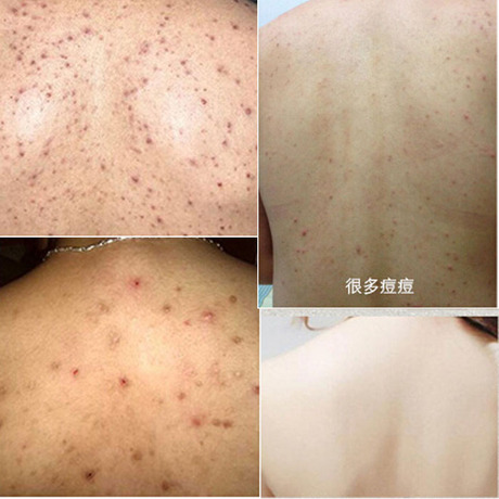 茶树美背喷雾胸前背上后背去痘背部祛痘去背部痘痘粉刺祛痘印全身