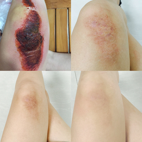 正品疤痕灵淡疤海藻修复膏产品淡化疤痕凹凸疤去除手术疤祛伤疤克