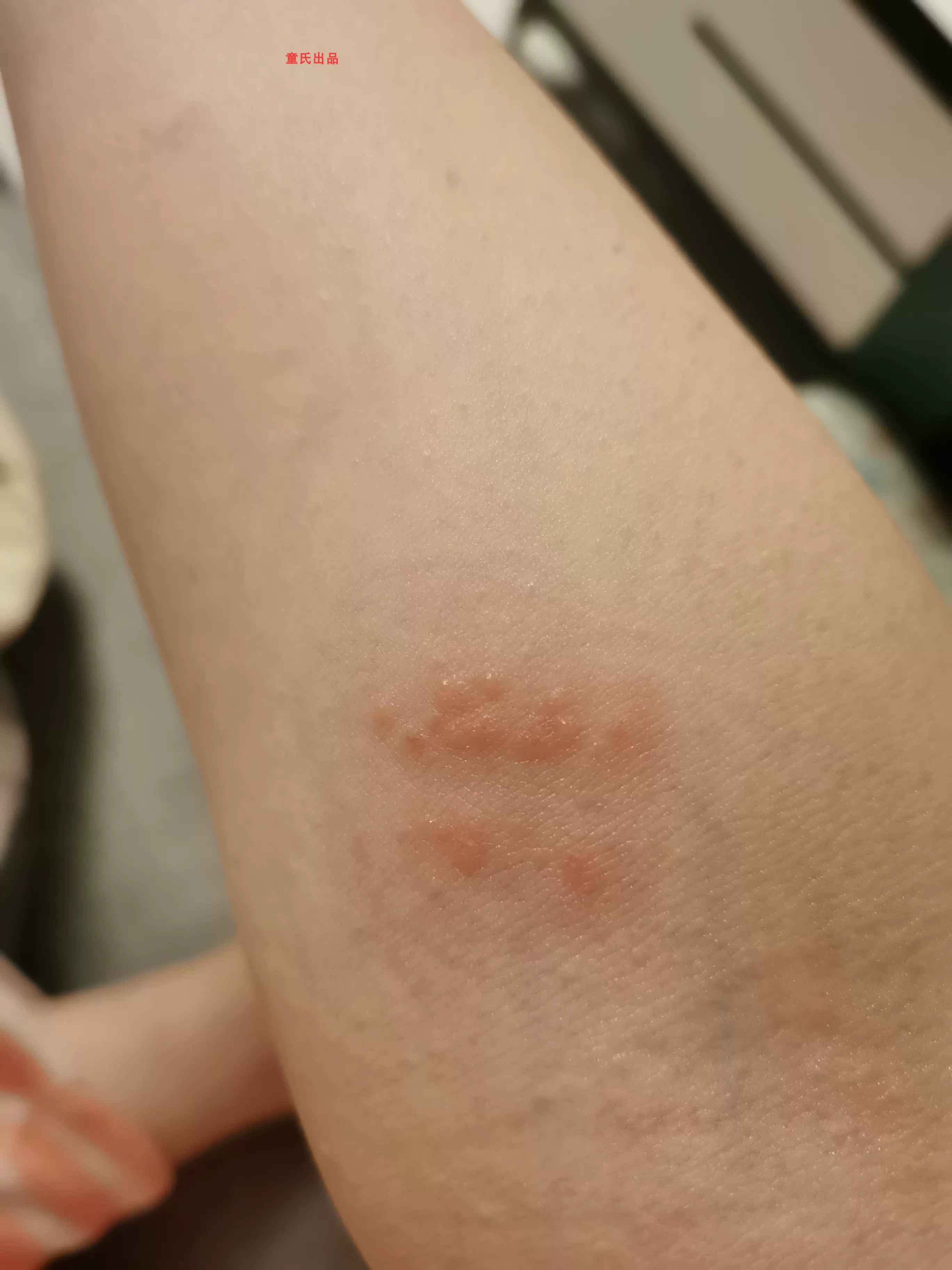 8去男女下面大腿两侧裆部阴毛处皮肤痒阴囊潮湿下体蛋蛋屁眼止痒-Taobao