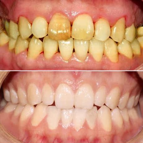 洁牙神器美白牙齿白牙素去烟渍去除牙渍黄牙牙菌斑洗牙粉水