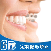 牙缝大隐形矫正牙套【多图】_价格_图片- 天猫