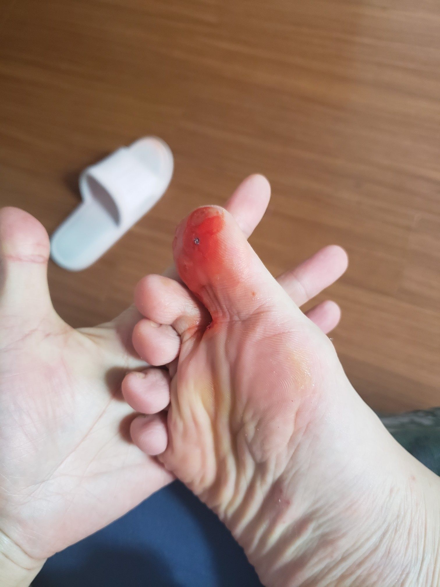 白云山鸡眼贴去脚鸡眼膏贴去除脚趾脚底鸡眼药足部根手部老茧肉刺