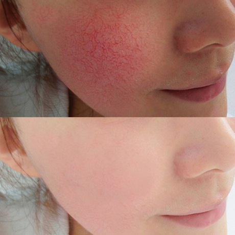 【拍3送1】玛雅帕帕拉面膜贴非晒后敏感肌肤红血丝抗敏感