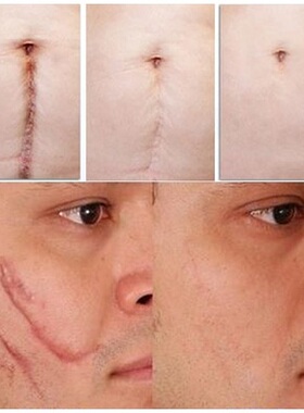 正品疤痕灵淡疤海藻修复膏产品淡化疤痕凹凸疤去除手术疤祛伤疤克