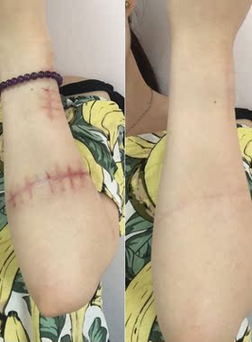 淡化疤痕灵修复疤痕膏疤痕手术刀伤疤凹凸祛去除男女痘印正品疤克