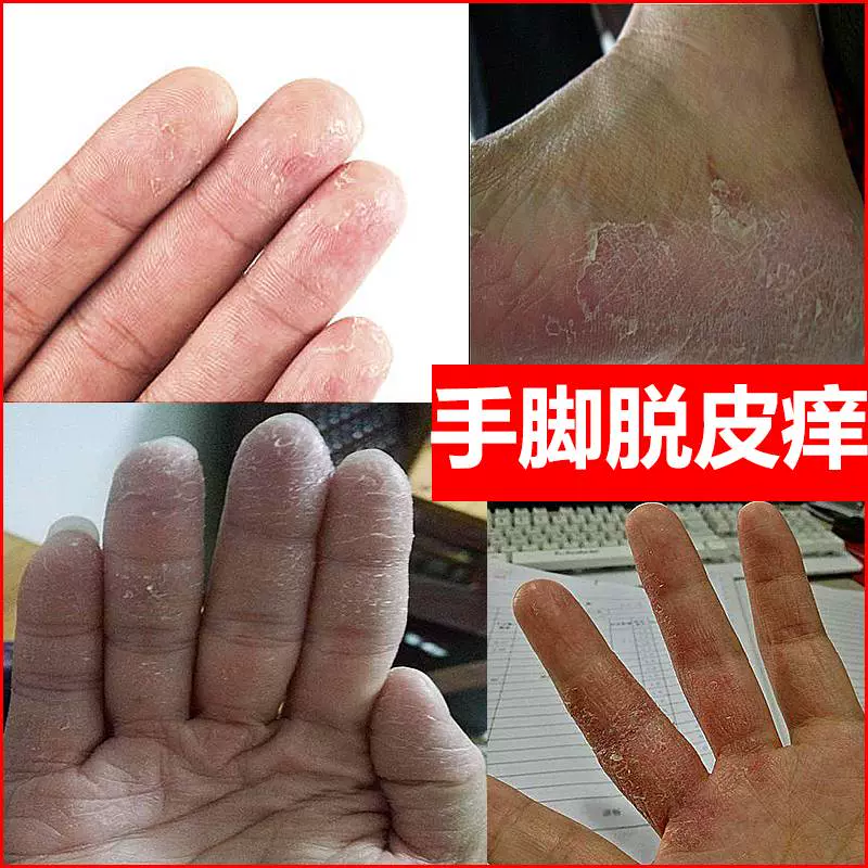脚藓水泡 新人首单立减十元 21年12月 淘宝海外 脚藓水泡 新人首单立减十元 21年12月 淘宝海外