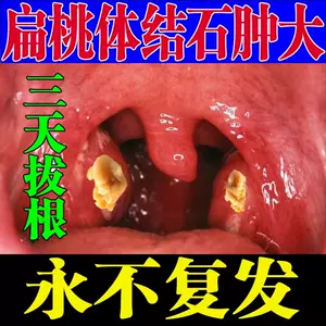 喉结石 新人首单立减十元 22年5月 淘宝海外