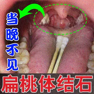 扁桃腺扁桃体结石 新人首单立减十元 22年5月 淘宝海外 扁桃腺扁桃体结石 新人首单立减十元 22年5月 淘宝海外