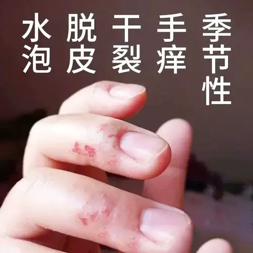 手部水泡膏 新人首单立减十元 21年12月 淘宝海外 手部水泡膏 新人首单立减十元 21年12月 淘宝海外