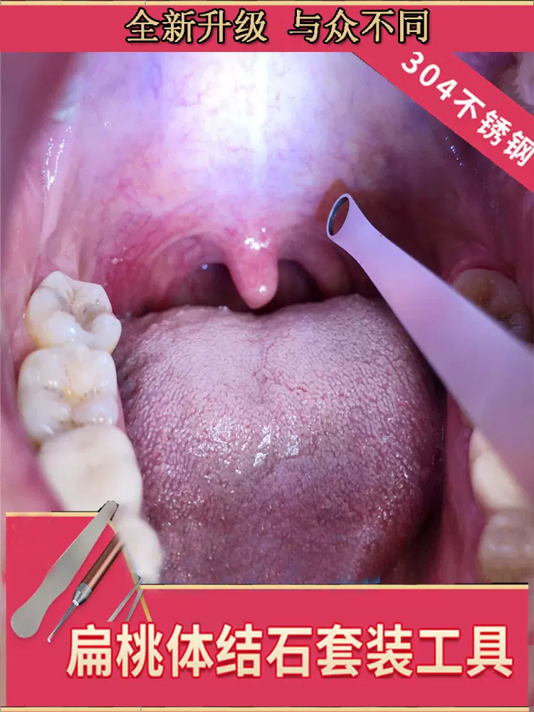 去扁桃体结石去除工具吸器清理神器扁导体扁桃腺结石隐窝挖 去扁桃体结石去除工具吸器清理神器扁导体扁桃腺结石隐窝挖