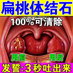 扁桃体结石22年5月 月销口碑最新推荐 天猫淘宝海外 扁桃体结石22年5月 月销口碑最新推荐 天猫淘宝海外
