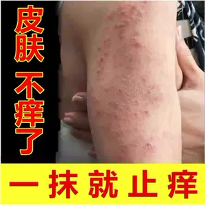 皮肤痒起红点 新人首单立减十元 22年6月 淘宝海外