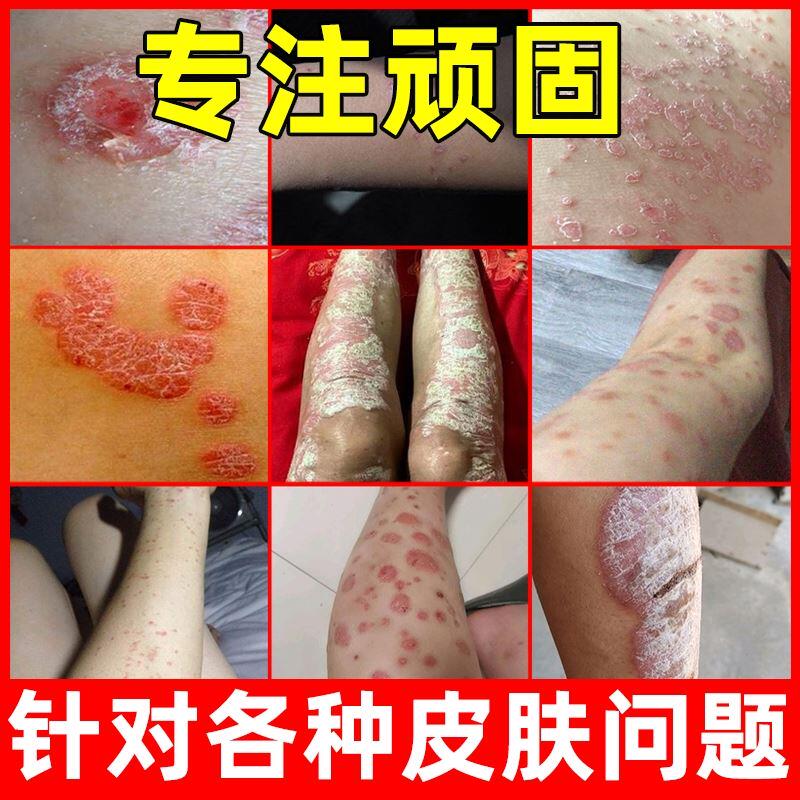 0【3支90元】苗丞堂苗草止i痒抑菌霜15g成人皮肤外用草本乳膏正品￥45