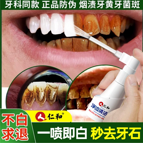 Удаление зуба камня, растворяющие зубной полон ртания, некачественная -аффильфы для мытья зуба, зубы, артефакты удаления желтого тартара