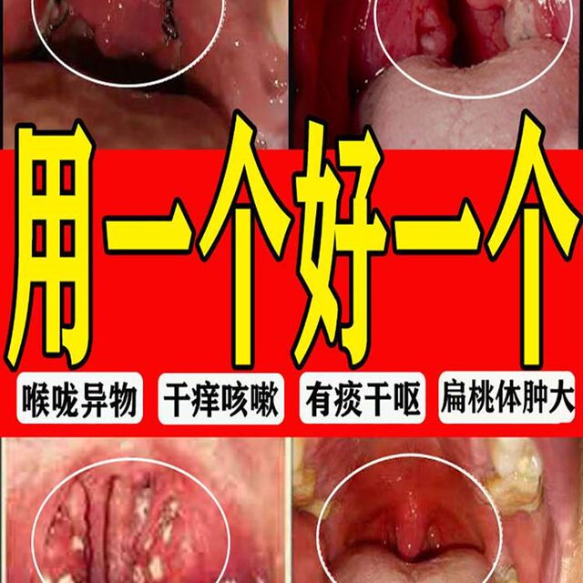 新品咽炎慢性咽炎除根咽喉炎秘方喉咙有痰异物感干燥发痒专用利喉