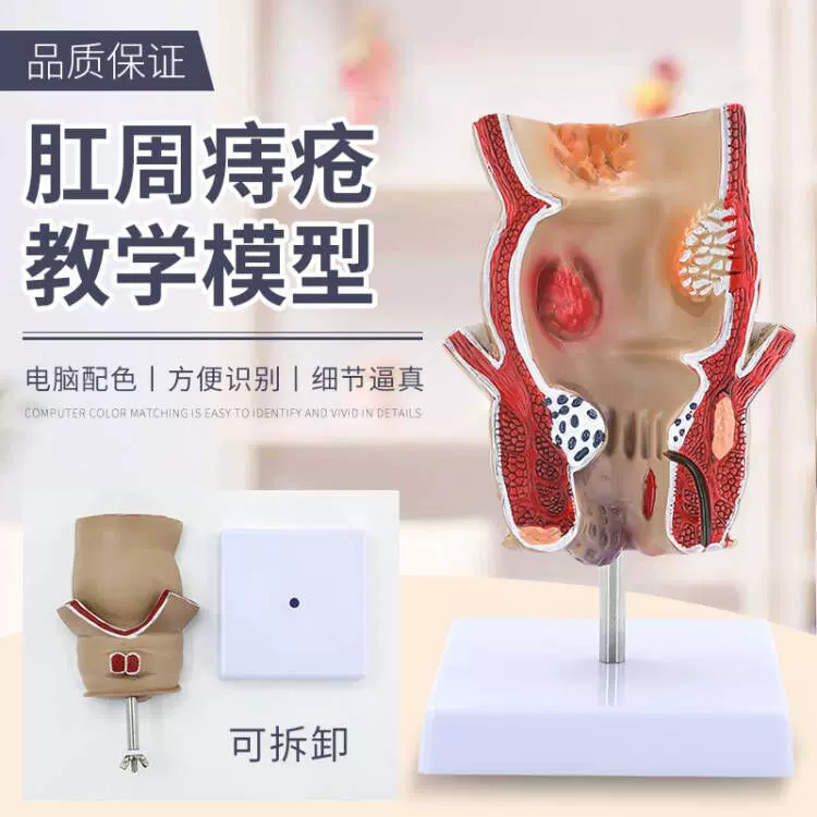 直腸痔瘡病變模型 痔瘡內外解剖 肛門肛腸科 大腸直腸病理模型-Taobao