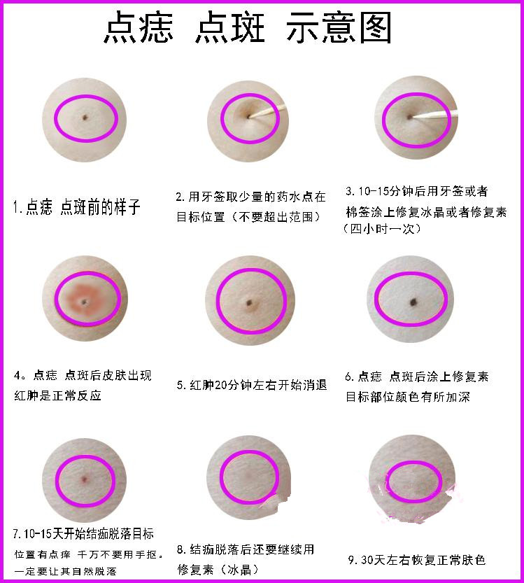 韦医生点痣灵的过程图图片