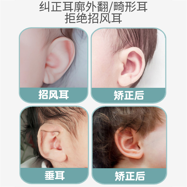 Baby Ear Correction Newborn Children's Auro Correction Patch Correcting Shapeing Forming Create outer earlobe baby