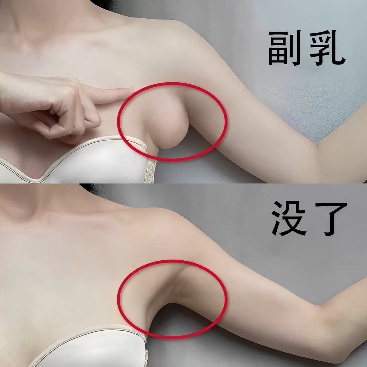 副乳 副乳消失术】去副乳神器疏通脖子腋下淋巴肿大结节通络副乳消除贴-Taobao Malaysia