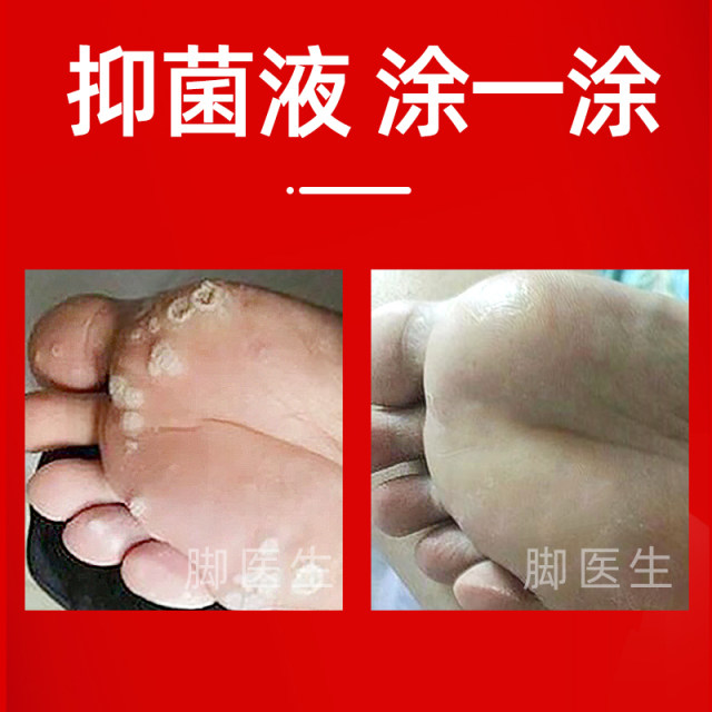 Foot doctor flagship store chicken eye creamy chicken eye stuck monkeys' foot meat thorns ointment toe warts clean hands and foot tweezo

