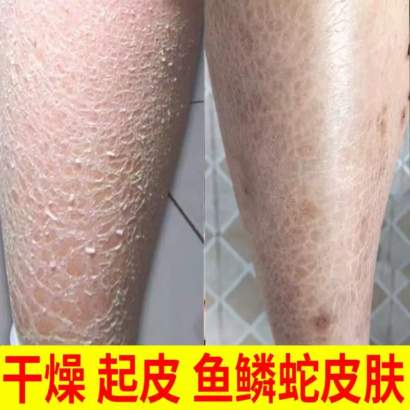 尿素霜滋潤保濕保濕腳後跟乾裂去小祛除魚鱗皮膚乾燥起皮護足霜膏 Taobao