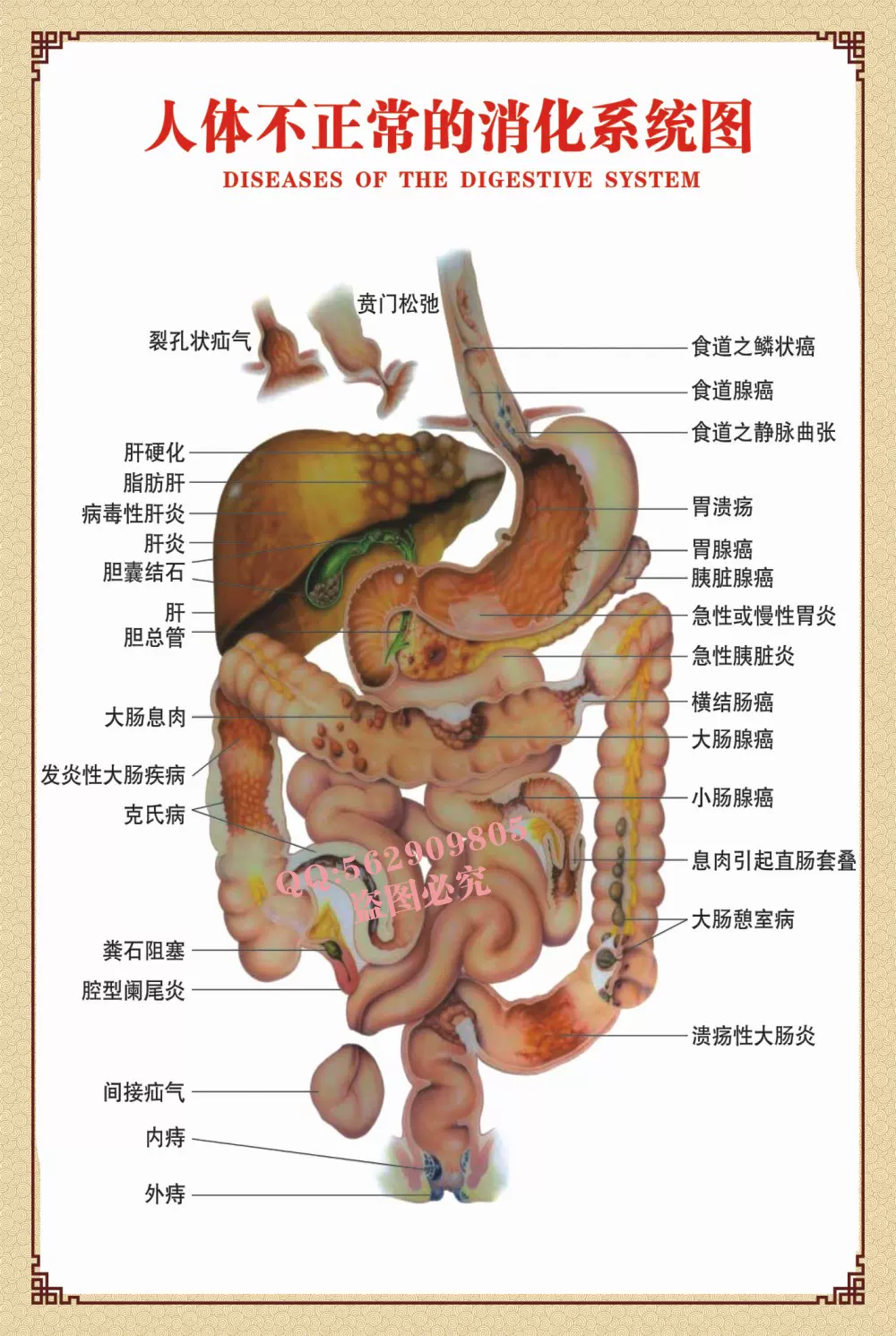 医学文化消化系统海报挂图壁画09 人体不正常的消化系统