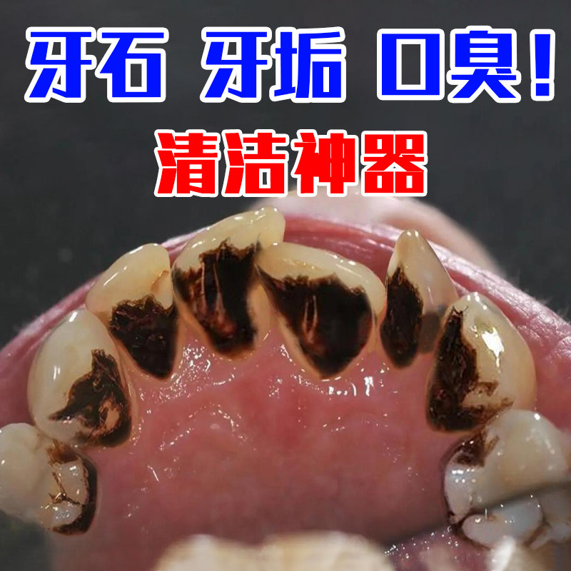 하얀 치아가 더 아름답다) 치석, 연기얼룩, 누런 치아, 치아때 청소 유물, 남녀공용 유물과 작별하세요 -