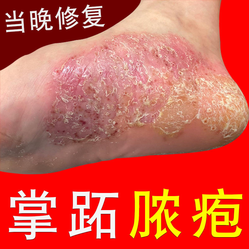 掌趾脓疱病掌跖角化症手脚红斑干裂蜕皮角皮症掌跖脓包病专用药膏-淘宝网
