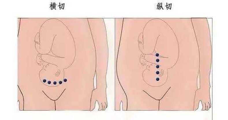 妇科腹腔镜切口位置图片
