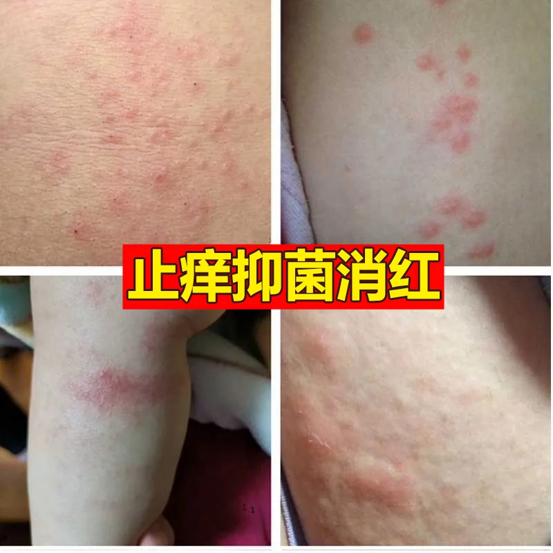 皮肤红点痒小腿起疙瘩过敏药百草止痒膏湿疹止痒去根身上干燥冬天 Taobao