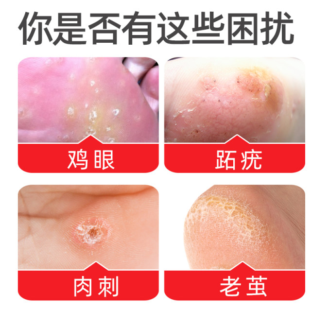 Foot doctor flagship store chicken eye creamy chicken eye stuck monkeys' foot meat thorns ointment toe warts clean hands and foot tweezo
