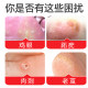 Foot doctor flagship store chicken eye creamy chicken eye stuck monkeys' foot meat thorns ointment toe warts clean hands and foot tweezo
